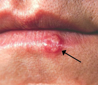 Чем и как лечить герпес на губах в домашних условиях